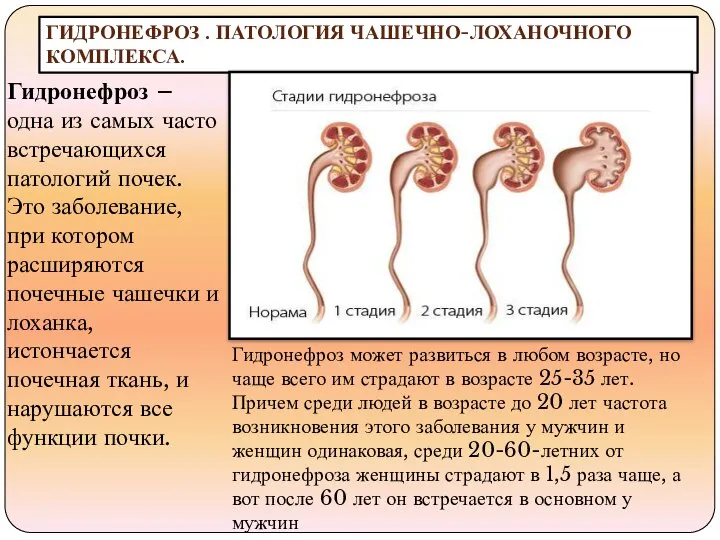 ГИДРОНЕФРОЗ . ПАТОЛОГИЯ ЧАШЕЧНО-ЛОХАНОЧНОГО КОМПЛЕКСА. Гидронефроз – одна из самых часто встречающихся