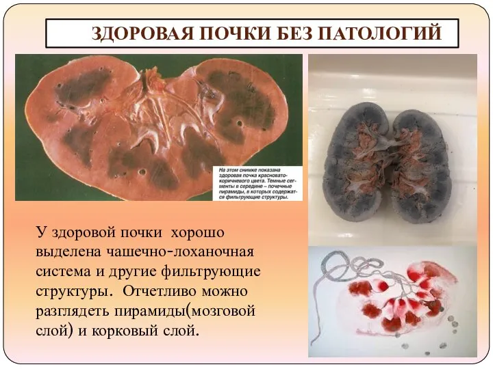 ЗДОРОВАЯ ПОЧКИ БЕЗ ПАТОЛОГИЙ У здоровой почки хорошо выделена чашечно-лоханочная система и