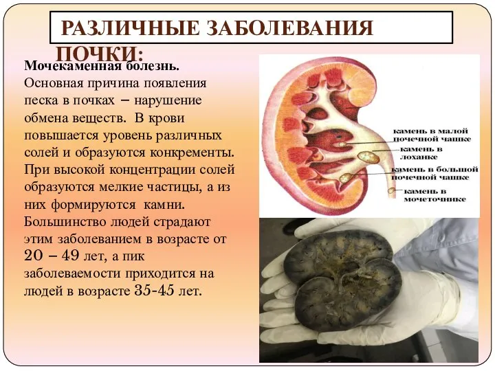 РАЗЛИЧНЫЕ ЗАБОЛЕВАНИЯ ПОЧКИ: Мочекаменная болезнь. Основная причина появления песка в почках –