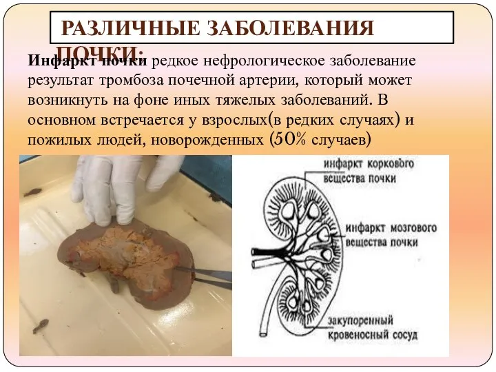 РАЗЛИЧНЫЕ ЗАБОЛЕВАНИЯ ПОЧКИ: Инфаркт почки редкое нефрологическое заболевание результат тромбоза почечной артерии,