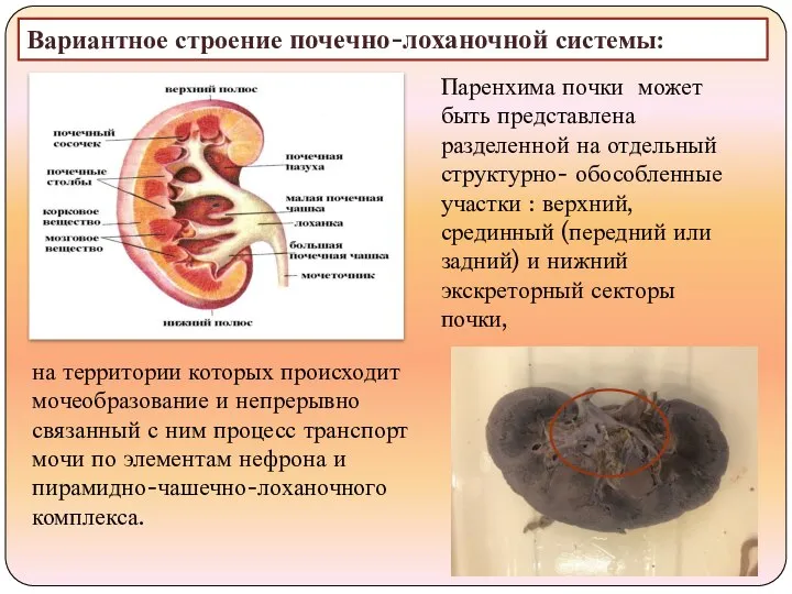 Вариантное строение почечно-лоханочной системы: Паренхима почки может быть представлена разделенной на отдельный