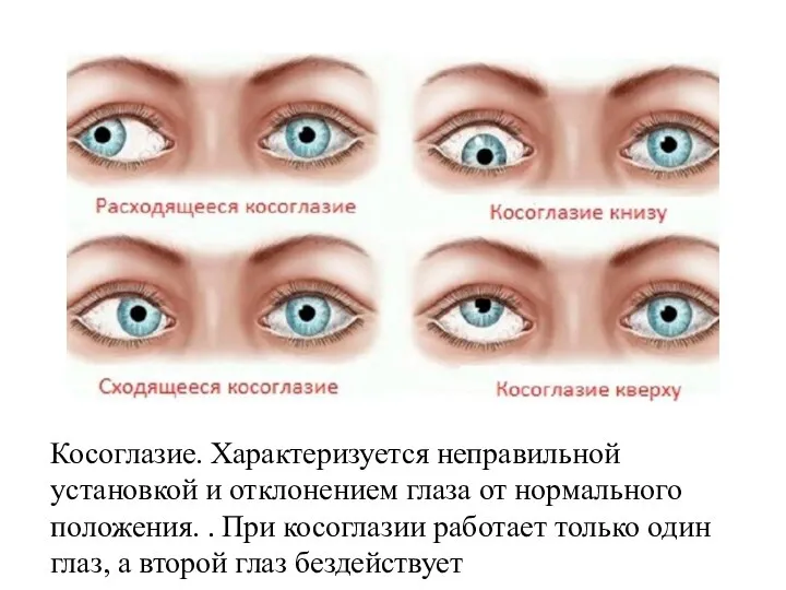 Косоглазие. Характеризуется неправильной установкой и отклонением глаза от нормального положения. . При