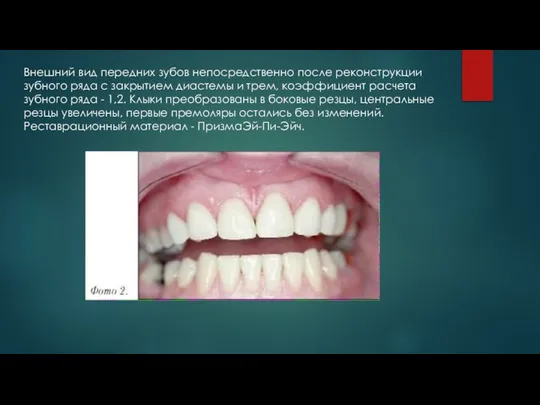 Внешний вид передних зубов непосредственно после реконструкции зубного ряда с закрытием диастемы