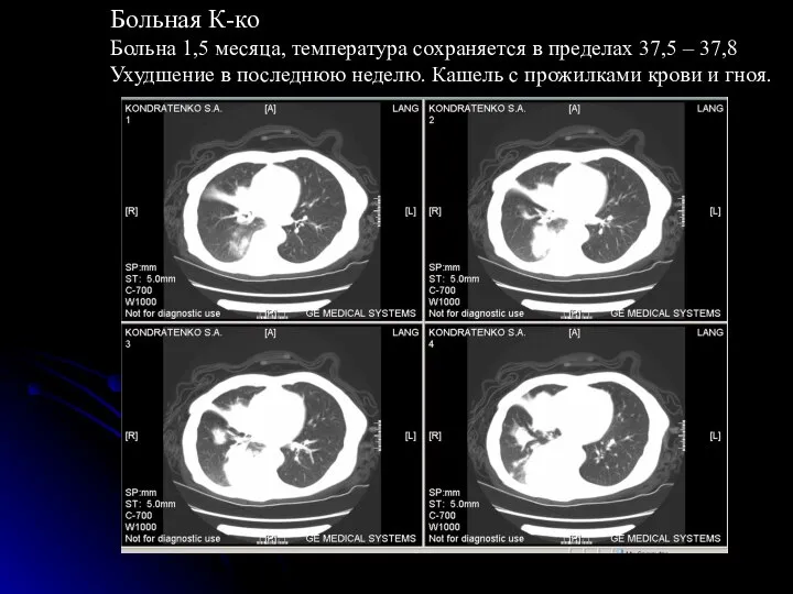 Больная К-ко Больна 1,5 месяца, температура сохраняется в пределах 37,5 – 37,8