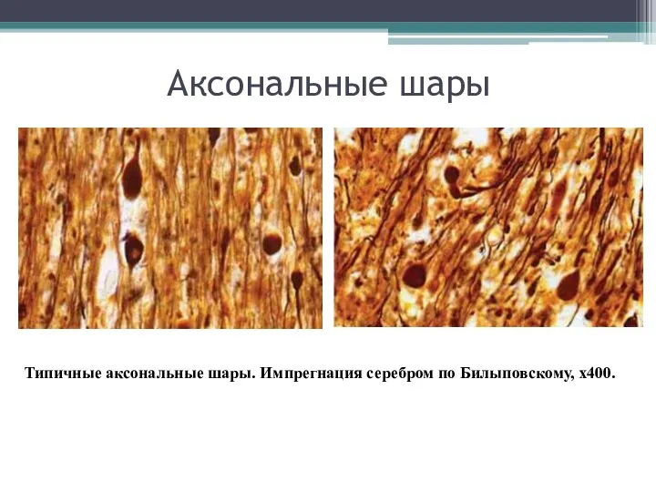 Аксональные шары Типичные аксональные шары. Импрегнация серебром по Билыповскому, х400.