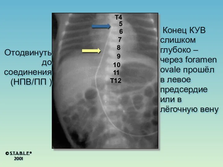 Конец КУВ слишком глубоко – через foramen ovale прошёл в левое предсердие