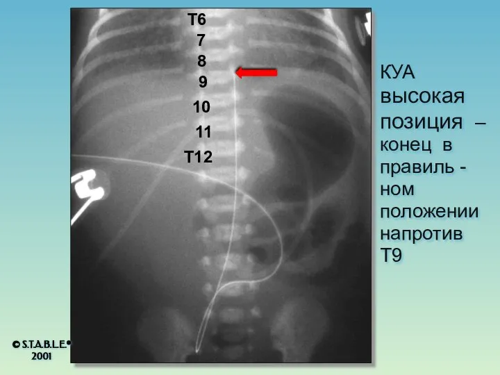 КУА высокая позиция – конец в правиль - ном положении напротив T9