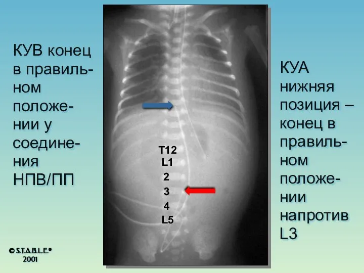 КУА нижняя позиция – конец в правиль-ном положе-нии напротив L3 T12 L1