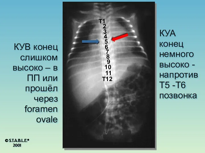 КУА конец немного высоко -напротив T5 -T6 позвонка КУВ конец слишком высоко