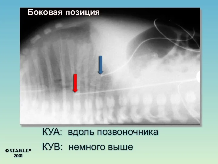 КУА: вдоль позвоночника КУВ: немного выше © S.T.A.B.L.E.® 2001