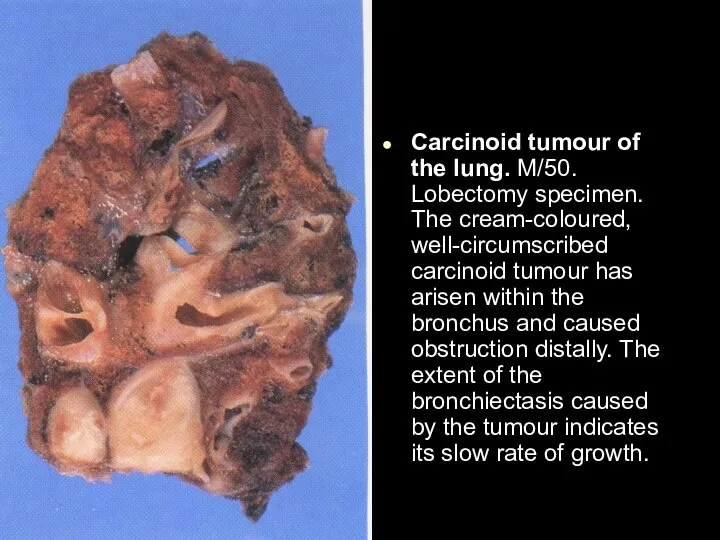 Carcinoid tumour of the lung. M/50. Lobectomy specimen. The cream-coloured, well-circumscribed carcinoid