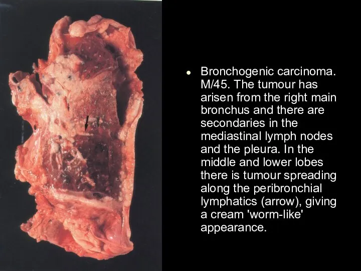 Bronchogenic carcinoma. M/45. The tumour has arisen from the right main bronchus