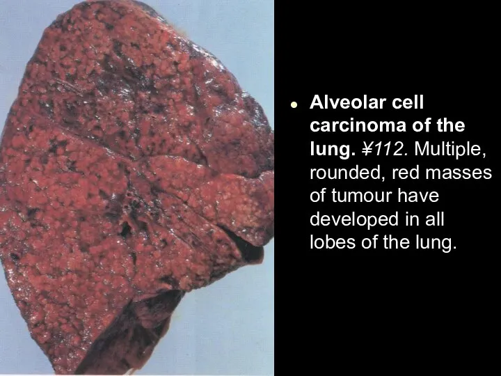 Alveolar cell carcinoma of the lung. ¥112. Multiple, rounded, red masses of