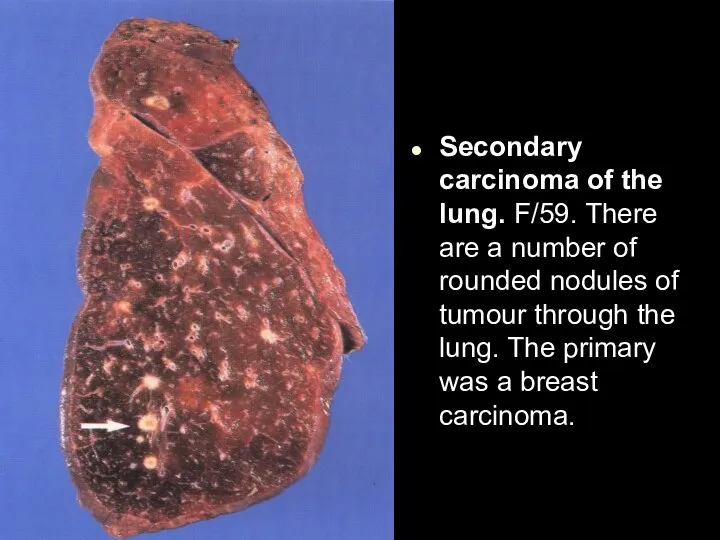 Secondary carcinoma of the lung. F/59. There are a number of rounded
