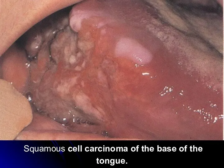 Squamous cell carcinoma of the base of the tongue.