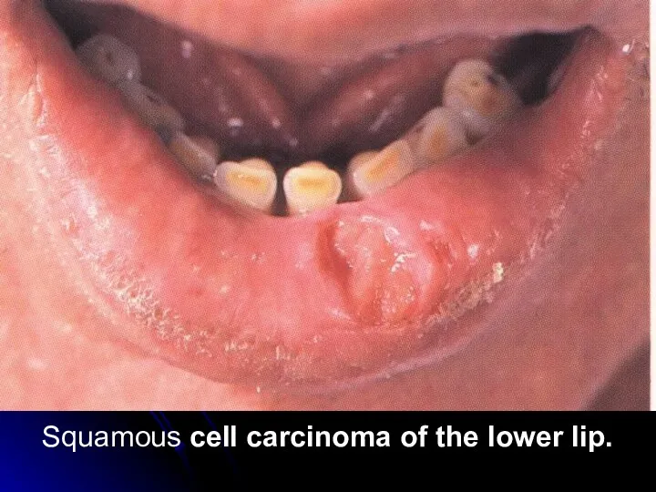 Squamous cell carcinoma of the lower lip.