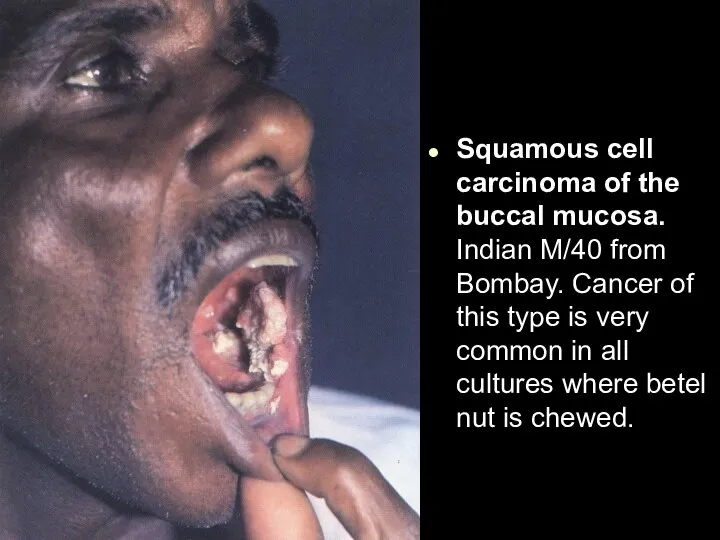 Squamous cell carcinoma of the buccal mucosa. Indian M/40 from Bombay. Cancer