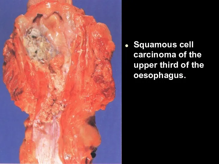Squamous cell carcinoma of the upper third of the oesophagus.