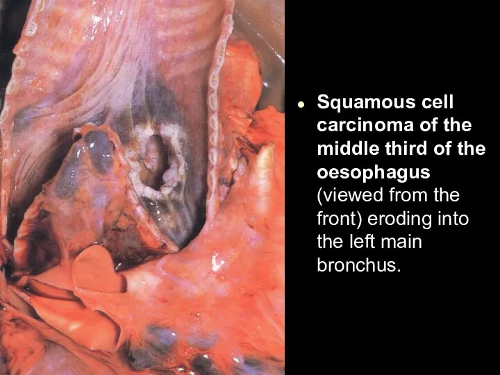 Squamous cell carcinoma of the middle third of the oesophagus (viewed from