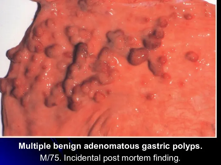 Multiple benign adenomatous gastric polyps. M/75. Incidental post mortem finding.
