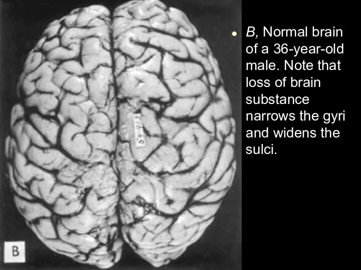 B, Normal brain of a 36-year-old male. Note that loss of brain