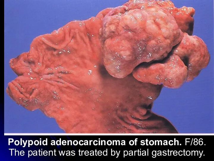 Polypoid adenocarcinoma of stomach. F/86. The patient was treated by partial gastrectomy.
