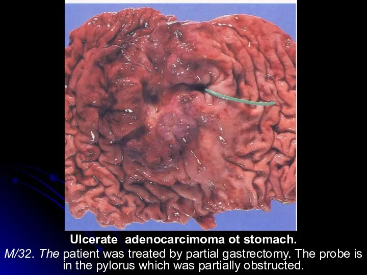 Ulcerate adenocarcimoma ot stomach. M/32. The patient was treated by partial gastrectomy.