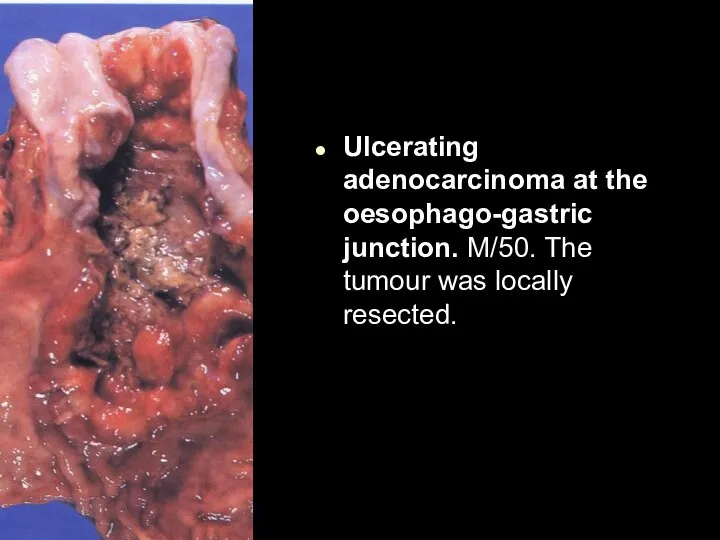 Ulcerating adenocarcinoma at the oesophago-gastric junction. M/50. The tumour was locally resected.
