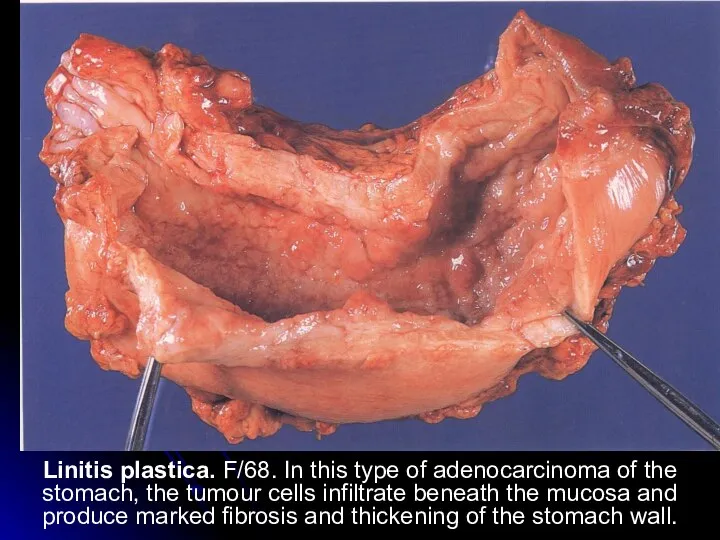 Linitis plastica. F/68. In this type of adenocarcinoma of the stomach, the