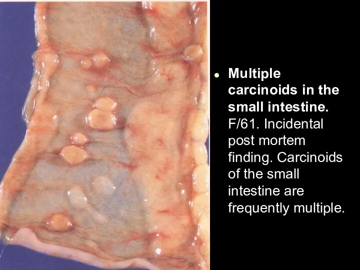 Multiple carcinoids in the small intestine. F/61. Incidental post mortem finding. Carcinoids