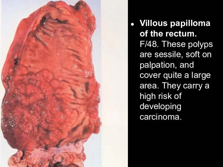 Villous papilloma of the rectum. F/48. These polyps are sessile, soft on