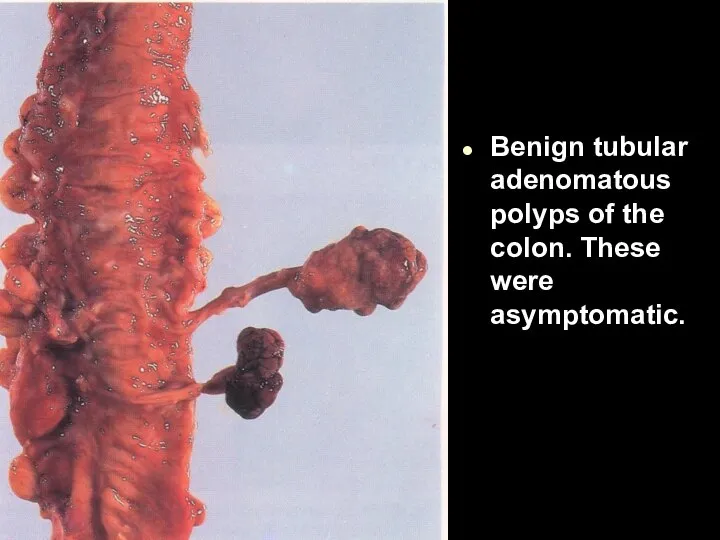Benign tubular adenomatous polyps of the colon. These were asymptomatic.
