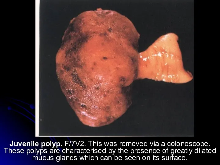 Juvenile polyp. F/7V2. This was removed via a colonoscope. These polyps are