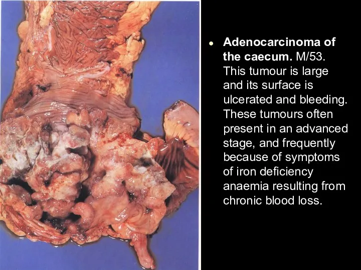Adenocarcinoma of the caecum. M/53. This tumour is large and its surface