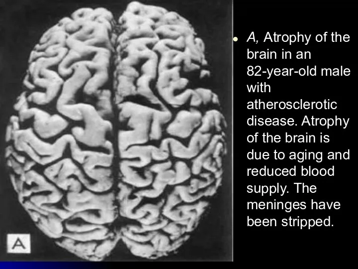 A, Atrophy of the brain in an 82-year-old male with atherosclerotic disease.