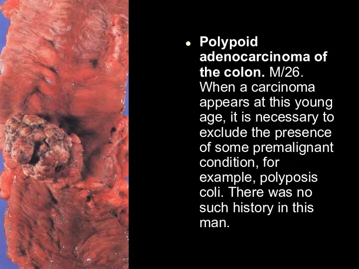 Polypoid adenocarcinoma of the colon. M/26. When a carcinoma appears at this