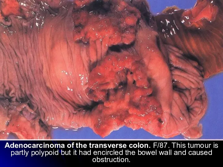 Adenocarcinoma of the transverse colon. F/87. This tumour is partly polypoid but