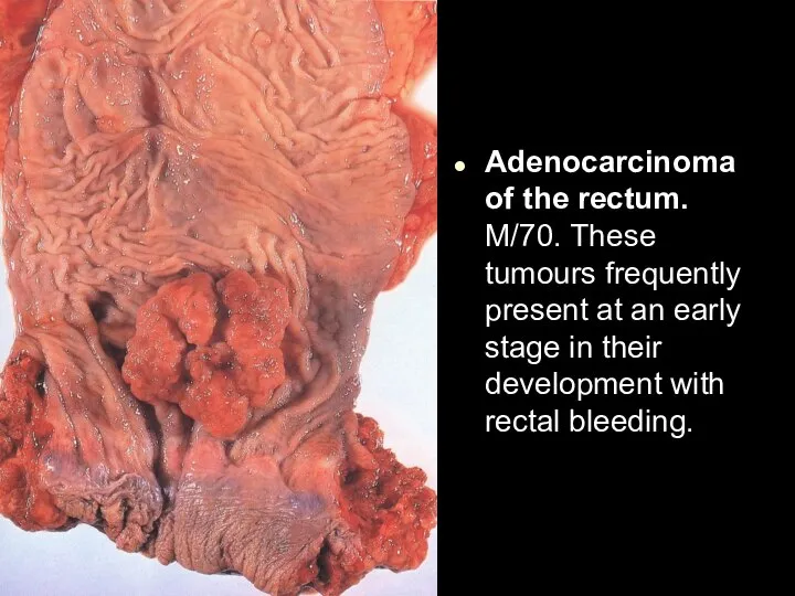 Adenocarcinoma of the rectum. M/70. These tumours frequently present at an early