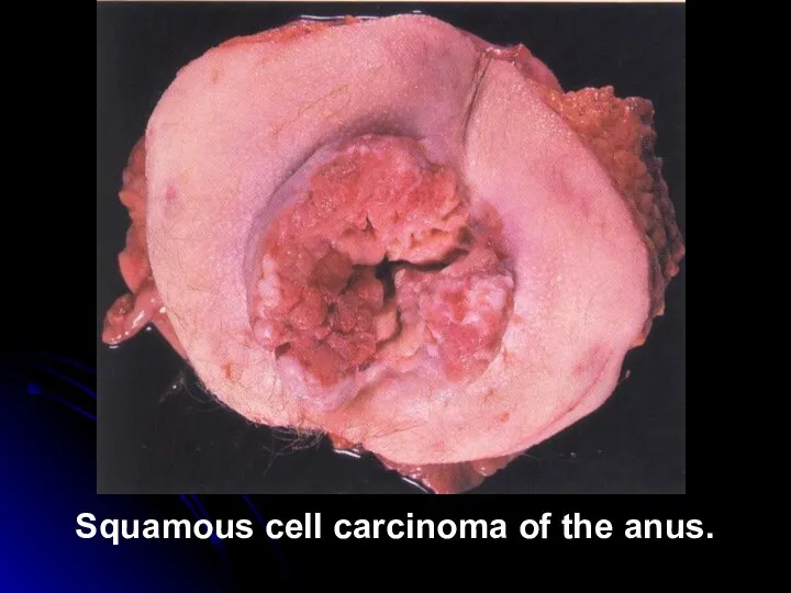 Squamous cell carcinoma of the anus.