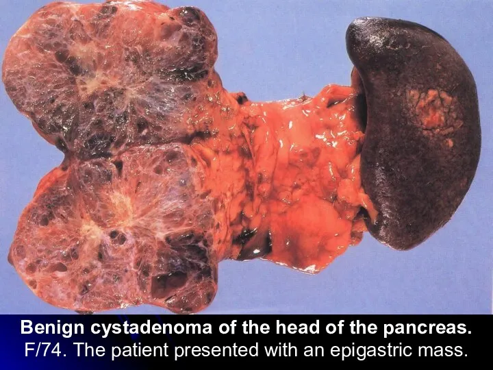 Benign cystadenoma of the head of the pancreas. F/74. The patient presented with an epigastric mass.