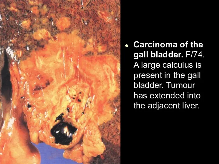 Carcinoma of the gall bladder. F/74. A large calculus is present in