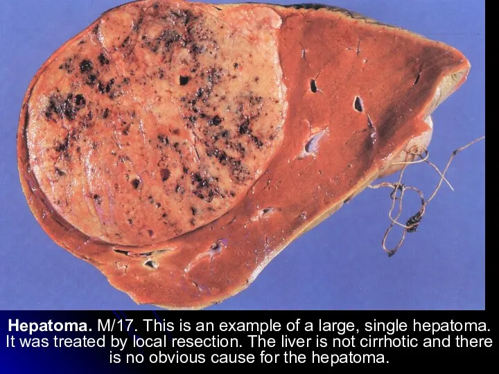Hepatoma. M/17. This is an example of a large, single hepatoma. It
