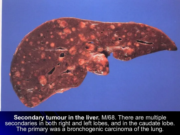 Secondary tumour in the liver. M/68. There are multiple secondaries in both