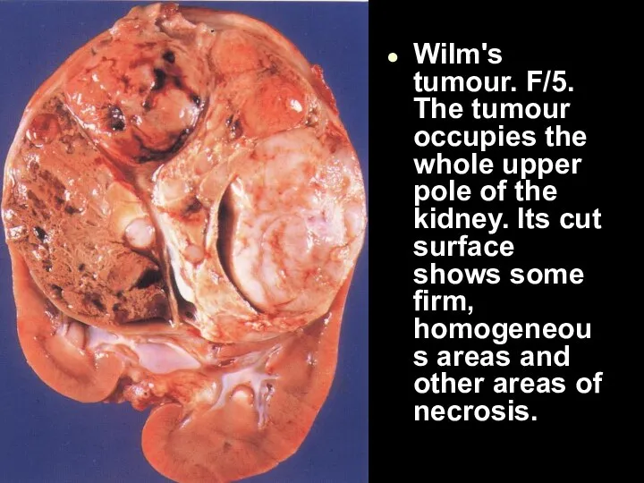 Wilm's tumour. F/5. The tumour occupies the whole upper pole of the