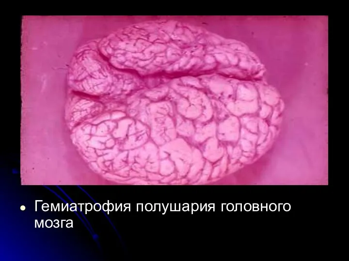 Гемиатрофия полушария головного мозга