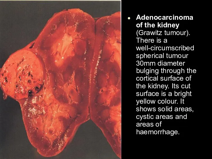 Adenocarcinoma of the kidney (Grawitz tumour). There is a well-circumscribed spherical tumour