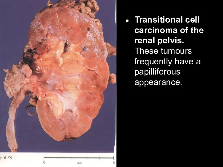 Transitional cell carcinoma of the renal pelvis. These tumours frequently have a papilliferous appearance.