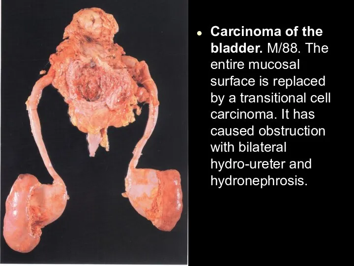 Carcinoma of the bladder. M/88. The entire mucosal surface is replaced by