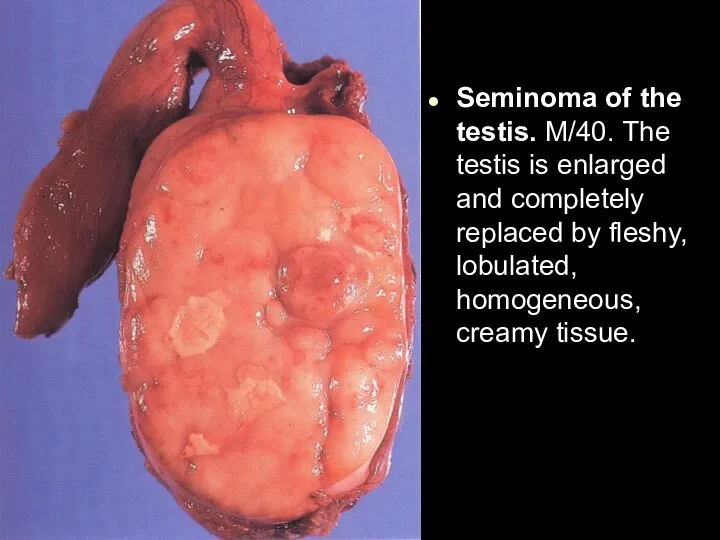 Seminoma of the testis. M/40. The testis is enlarged and completely replaced
