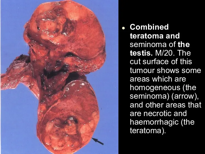 Combined teratoma and seminoma of the testis. M/20. The cut surface of